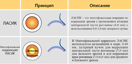 Multifocal LASIK for presbyopia