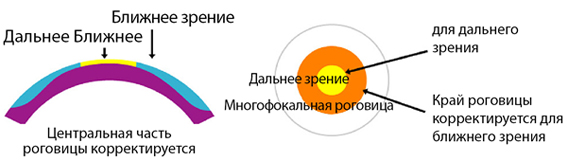 Multifocal LASIK for presbyopia